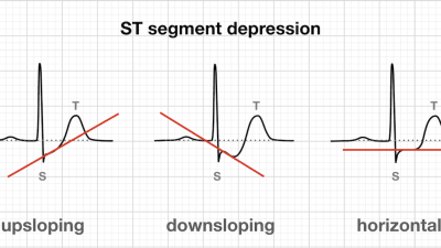 The ST Segment • LITFL • ECG Library Basics